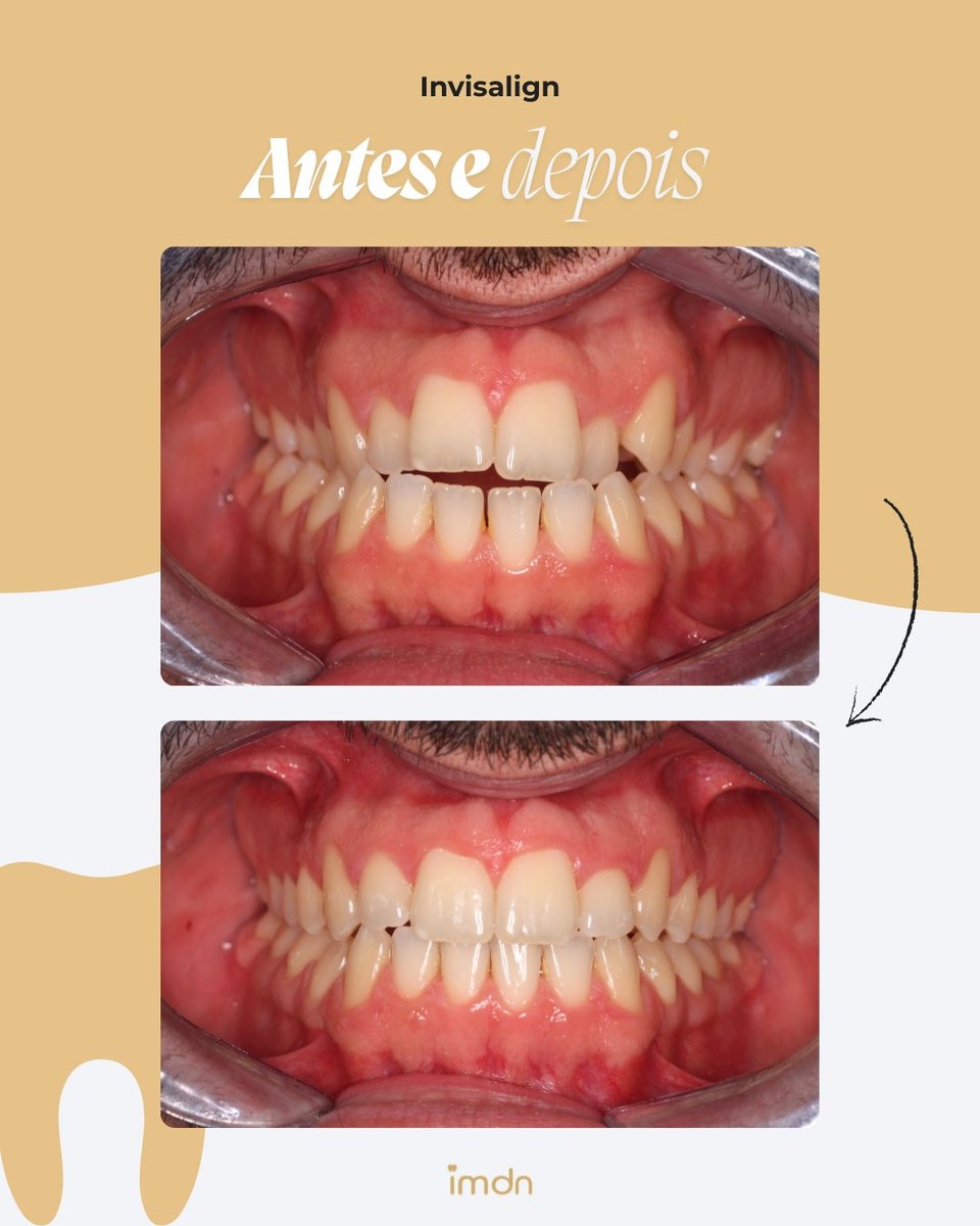Alinhamento com alinhadores invisíveis Invisalign